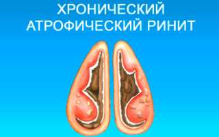 Можно ли греть нос при насморке солью