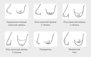 Как вернуть красивую форму груди после кормления, не прибегая к пластике