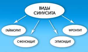 Лечение гнойных выделений из носа