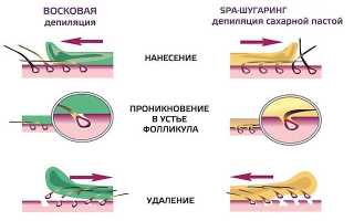 Как удалить волосы на руках с помощью популярных методов депиляции