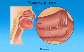 Лекарство от полипов в носу