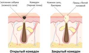 Как избавиться чёрных точек на лице: эффективные методы борьбы с комедонами