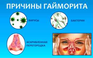 Использование аэрозолей с антибиотиками при лечении гайморита