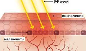Загар: как образуется и каких видов бывает
