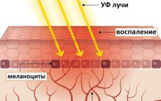Загар: как образуется и каких видов бывает