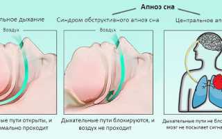 Эффективность препарата Доктор Храп при ронхопатии