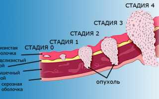 Плоскоклеточный рак гортани
