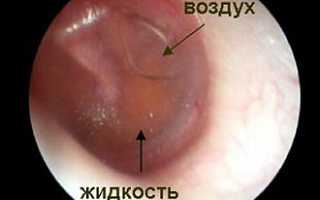 Симптомы среднего отита у взрослых