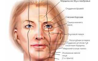 Лифтинг: как и кому делается эта процедура