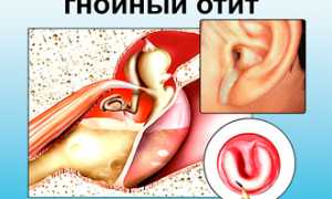 Можно ли посещать баню и сауну с насморком