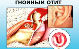 Можно ли посещать баню и сауну с насморком