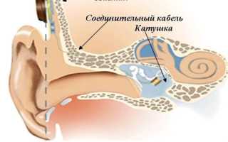 Виды и категории слуховых аппаратов