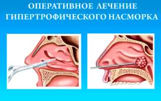 Способы лечения гипертрофического насморка хронической формы