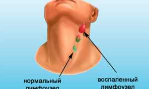 Разновидности трахеита