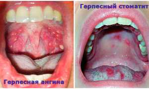 Герпесная ангина – советы доктора Комаровского