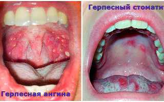 Герпесная ангина – советы доктора Комаровского