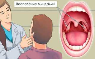 Боль в горле – чем лечить в домашних условиях?