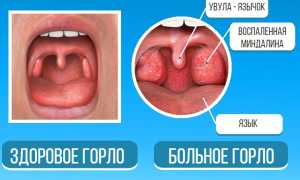 Лечение распухшего язычка в горле