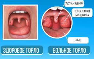 Лечение распухшего язычка в горле
