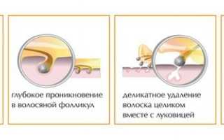 Бандажная техника шугаринга: как подготовиться и сделать