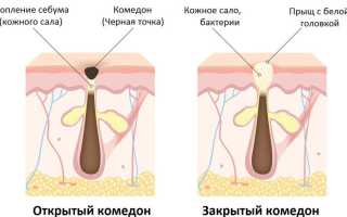 Масло от чёрных точек: как сделать правильный выбор