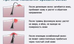 Как избавиться от вросших волос в зоне бикини