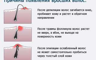 Как избавиться от вросших волос в зоне бикини