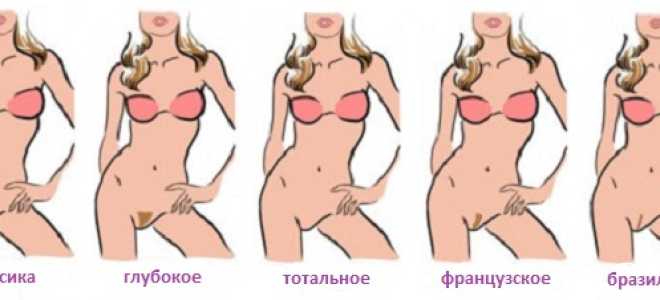 Шугаринг бикини: что нужно знать о процедуре