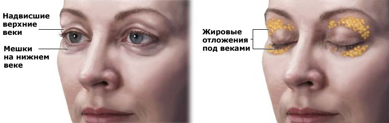 Схема расположения жира вокруг глаз
