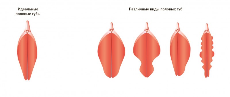 виды малых половых губ