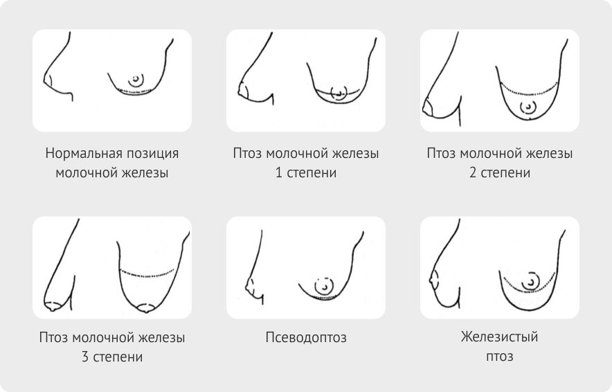 птоз груди