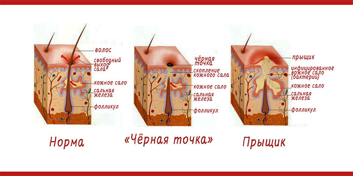 Схема образования комедона и прыща