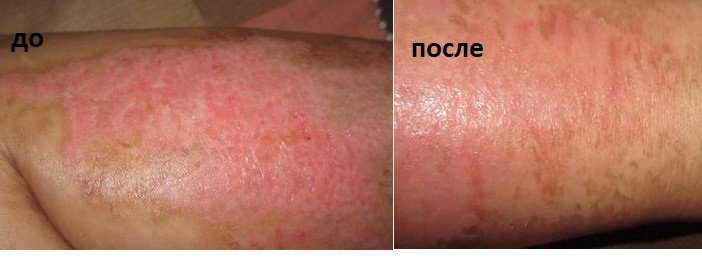 обожжённый участок кожи до и после применения амарантового масла