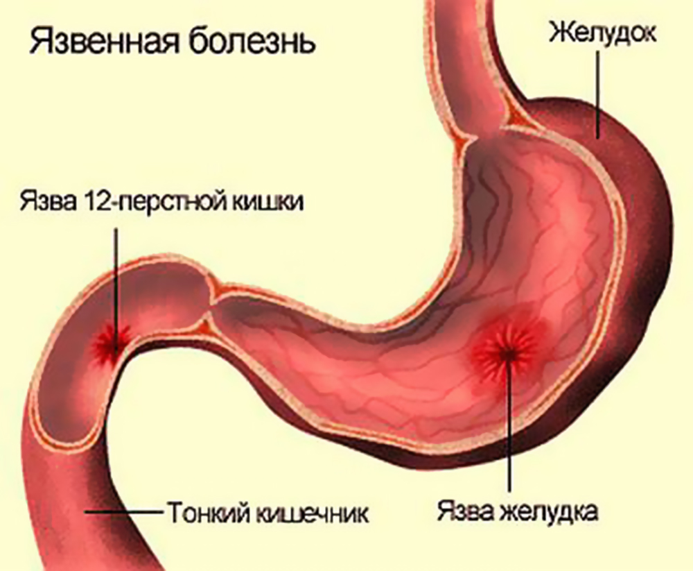 Болезни пищеварительной системы