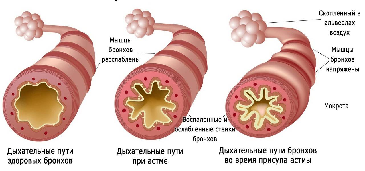 Бронхи: здоровые и при астме