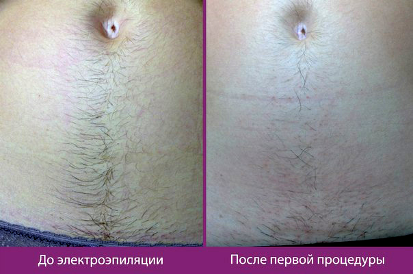 электроэпиляция живота