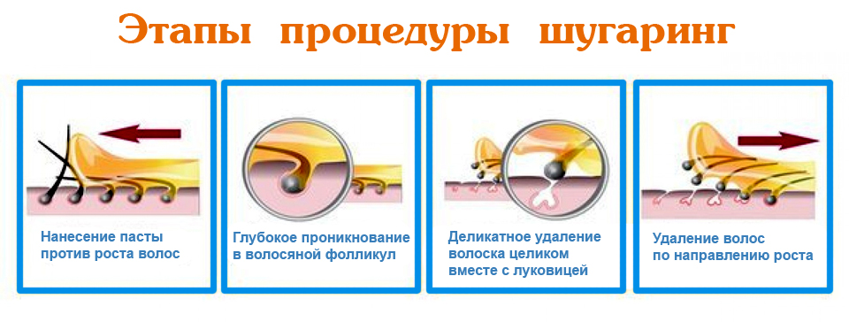 Этапы процедуры шугаринга