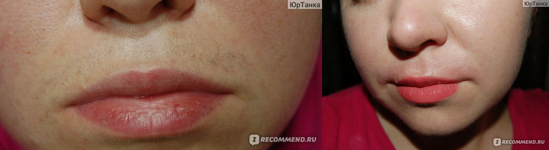 Фото верхней губы до и после восковой депиляции