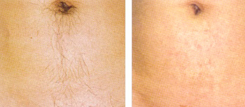 Фотоэпиляция живота