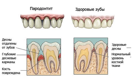 Генерализованный пародонтит