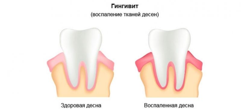 Гингивит