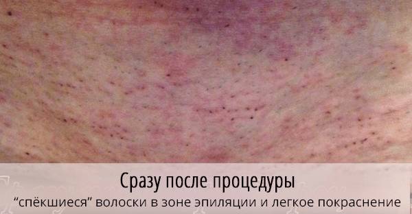 Кожа в области бикини после эпиляции