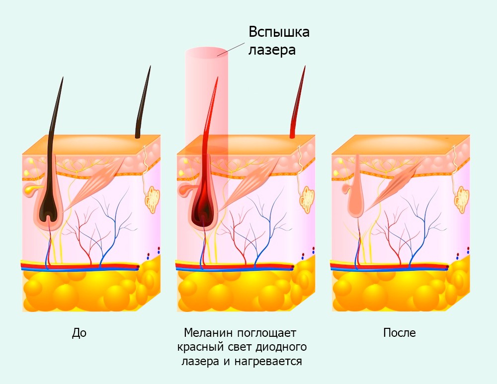 Лазер, волосы, инфракрасный свет (схематическое изображение)