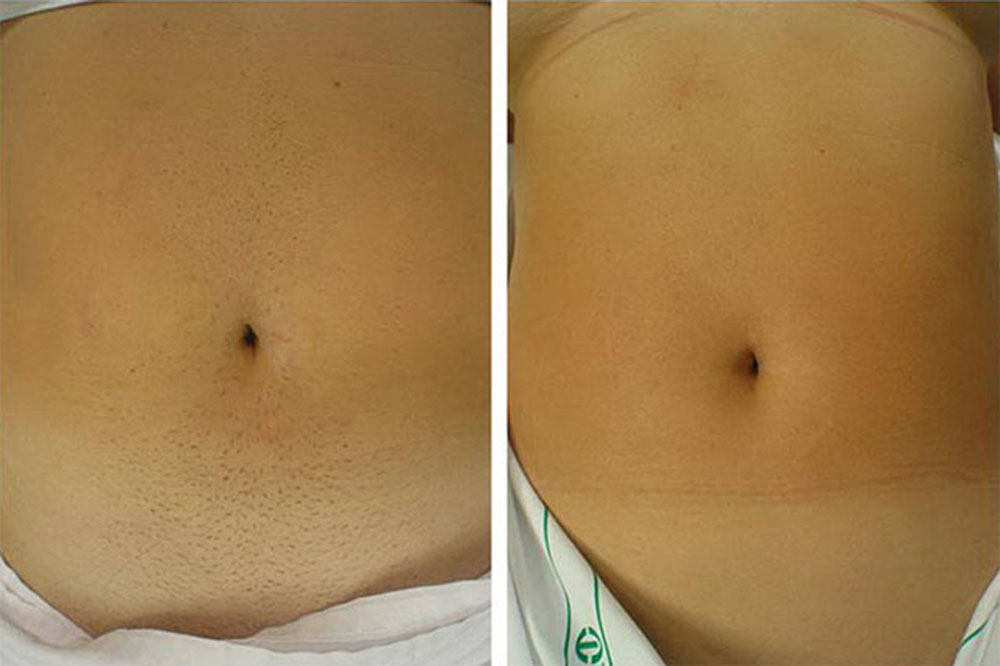 Лазерная эпиляция живота