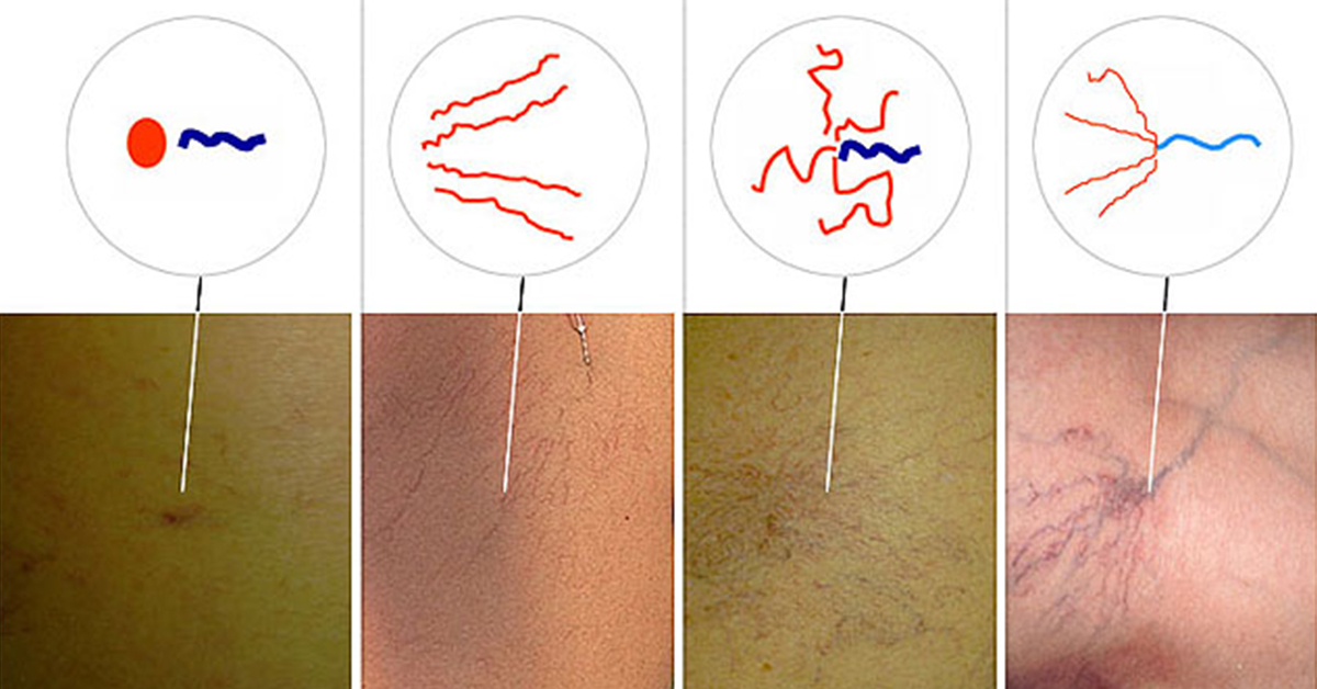 ломкие сосуды