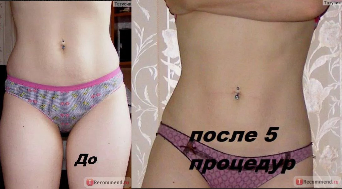 Обёртывание с горчицей фото до и после