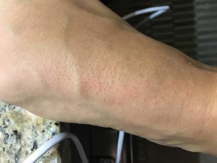 Нога после депиляции горячим воском