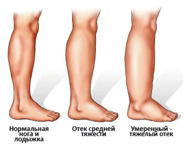 Отёчность ног