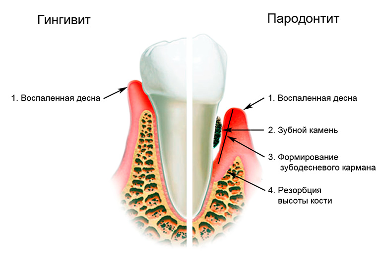 Отличие пародонтита от гингивита