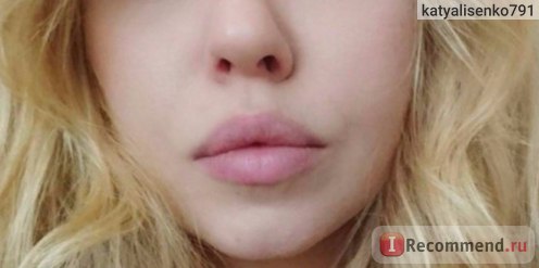 Введение диспорта: фото до процедуры